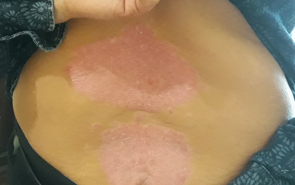 traitement naturopathie psoriasis