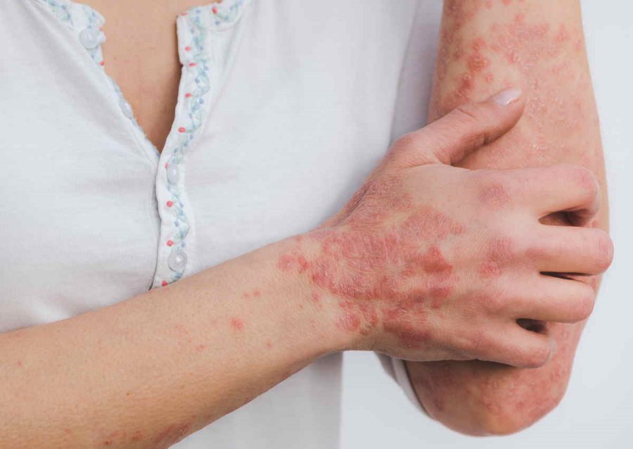 traitement psoriasis au coude