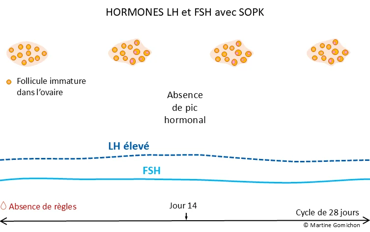 modification LH FSH avec SOPK