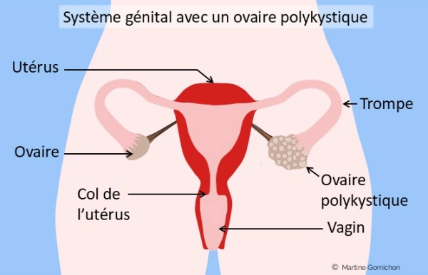 image ovaire polykystique